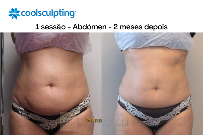 coolsculpting 2 meses depois