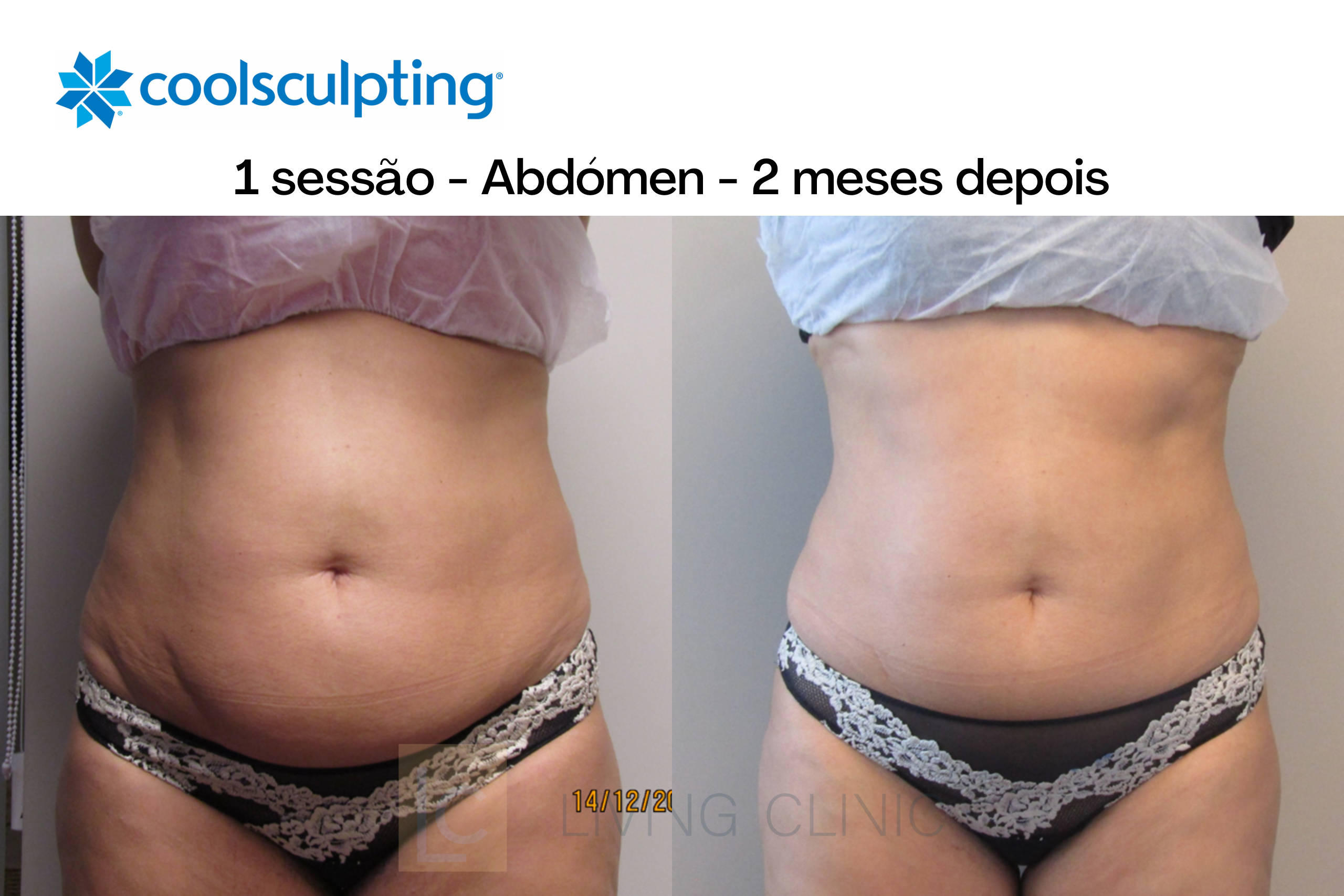 coolsculpting 2 meses depois