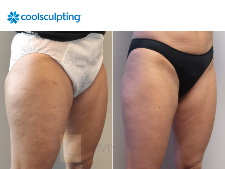 coolsculpting coxas mulher antes e depois