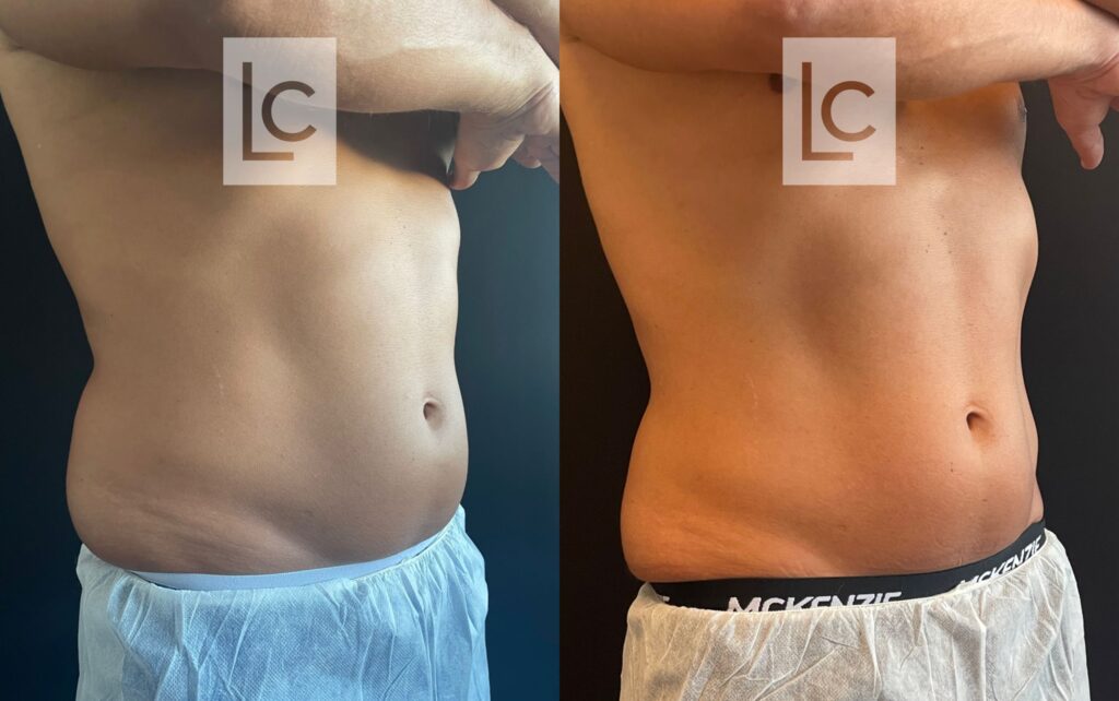 Tudo sobre o EMSCULPT