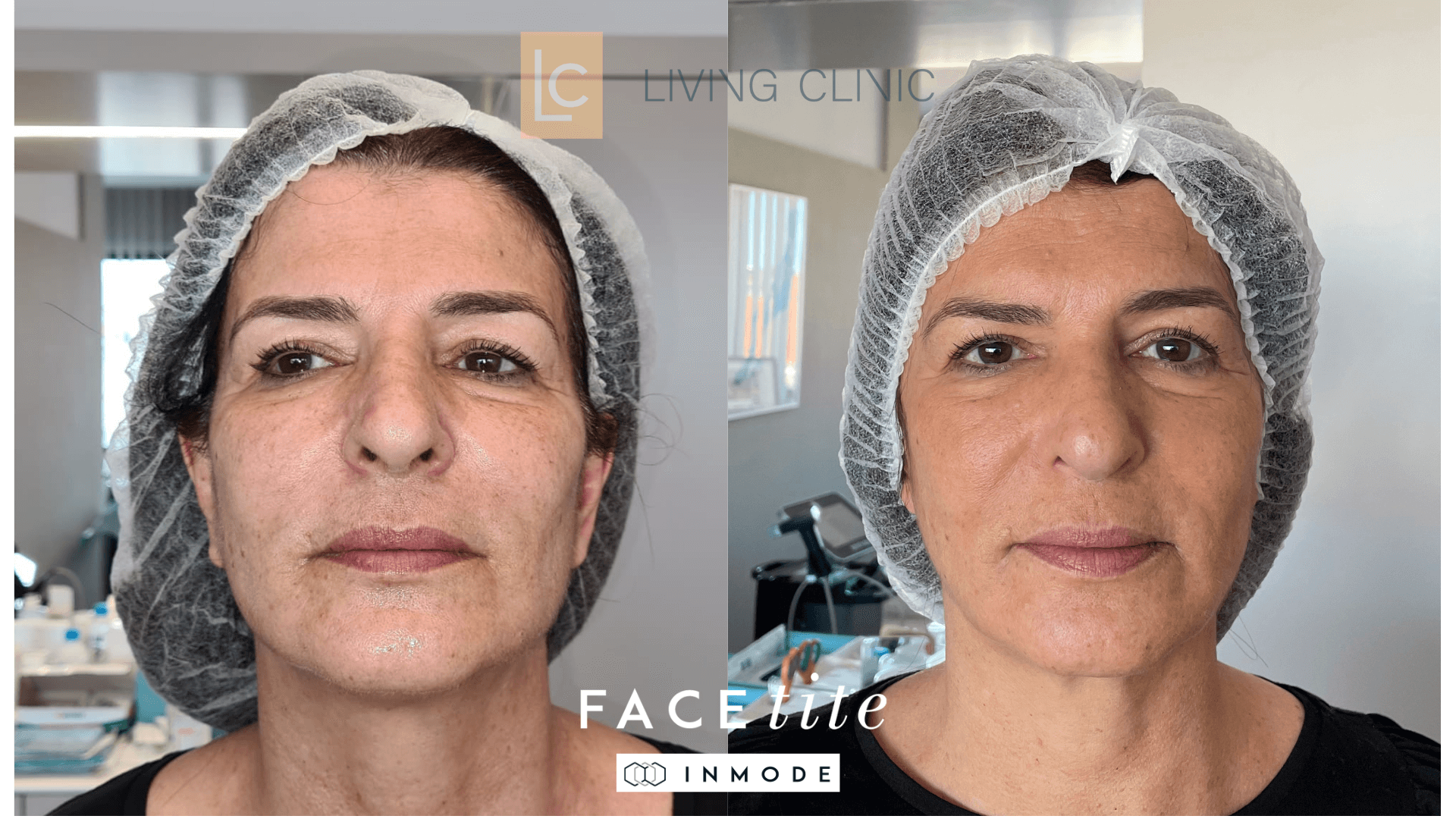 Facial Sagginess Treatment
