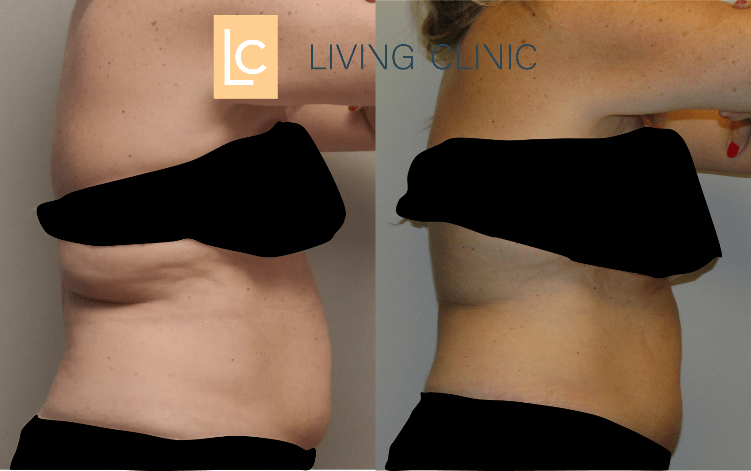 EMSculpt NEO and Coolsculpting combined results