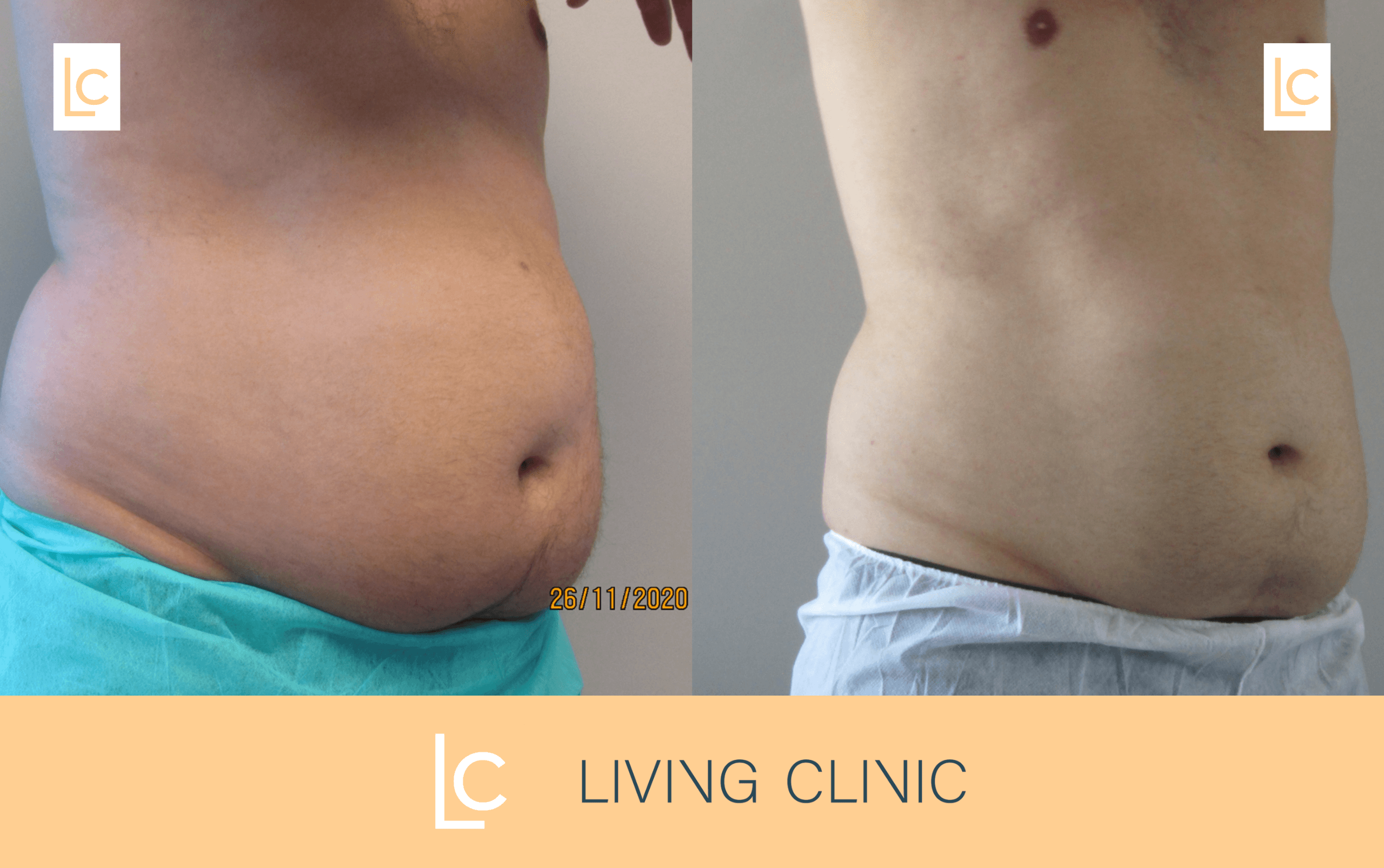 50 year old Male Abdomen Coolsculpting Cryolipolysis Results