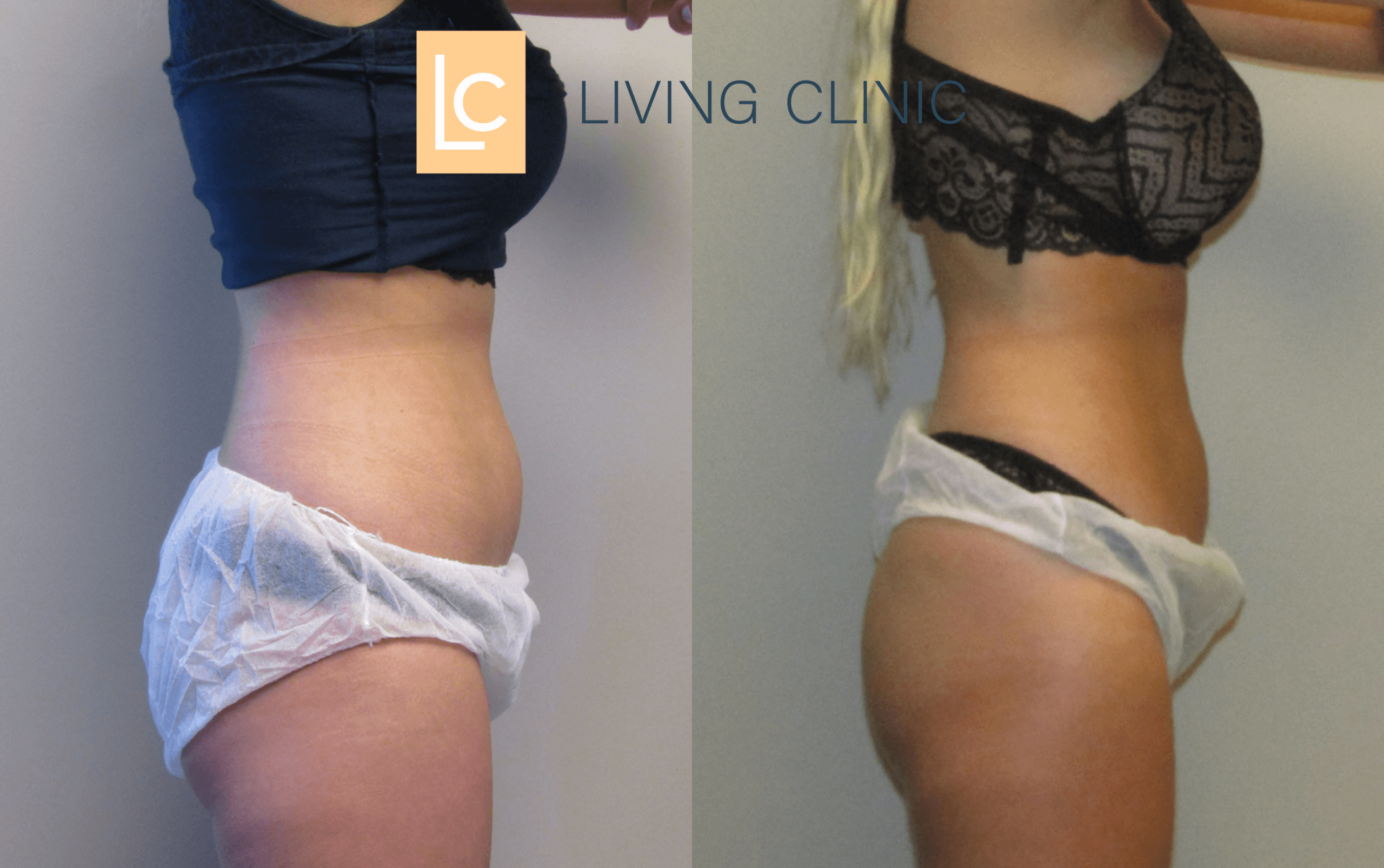 Lower Abdomen Coolsculpting Cryolipolysis Results