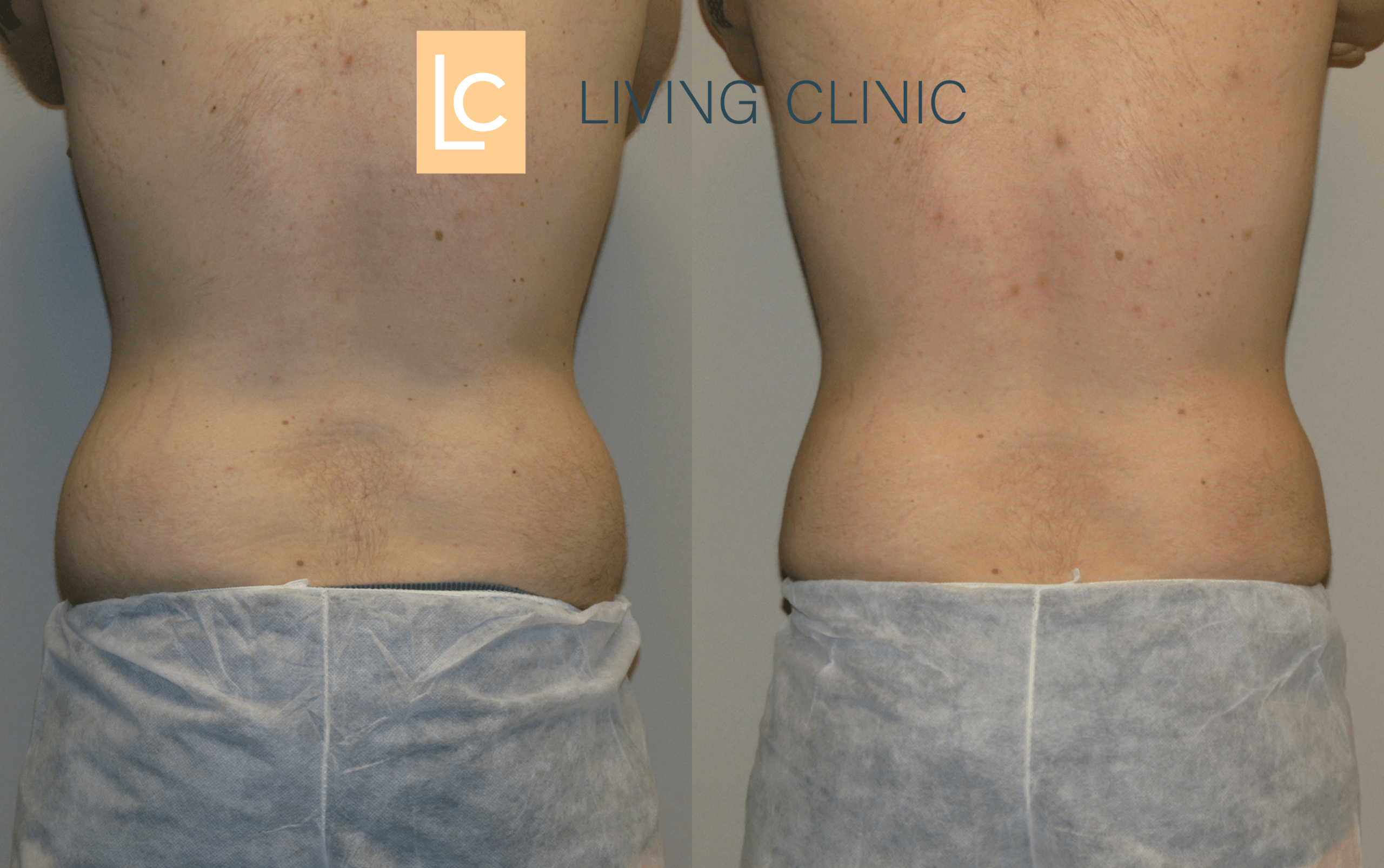 Male Flanks Coolsculpting Cryolipolysis Results