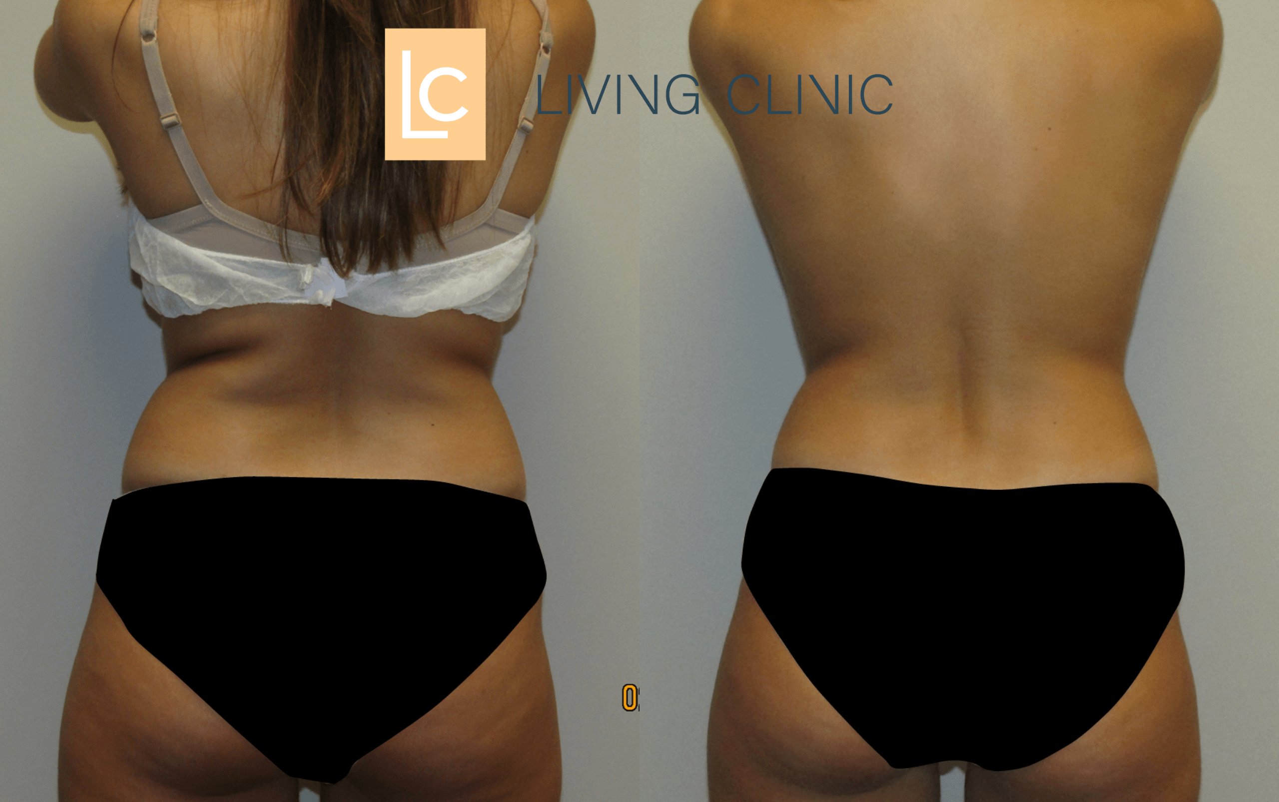 Female Upper Flanks Coolsculpting Cryolipolysis Results
