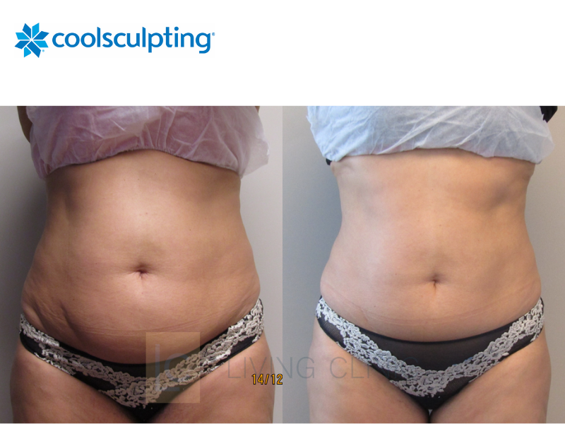 coolsculpting gordura localizada antes e depois