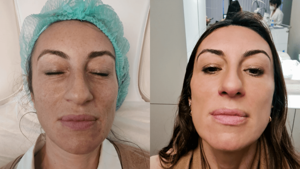 luz pulsada antes e depois