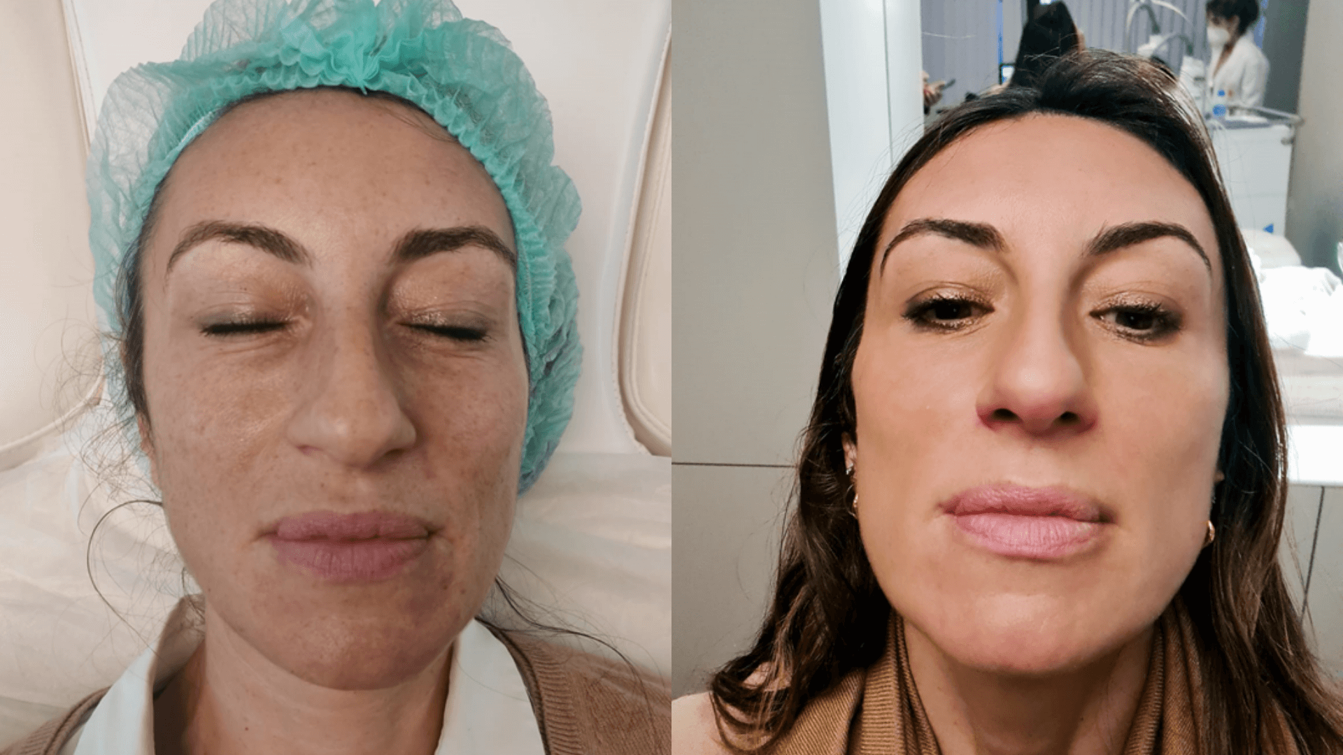 tratamento de rejuvenescimento facial