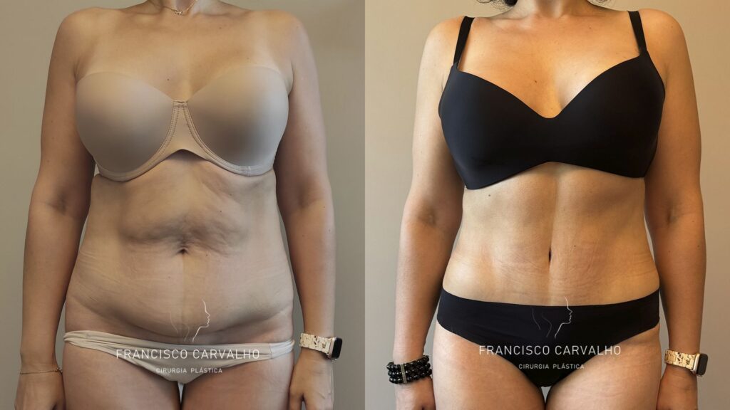 abdominoplastia com lipoaspiração (lipoabdominoplastia) antes e depois