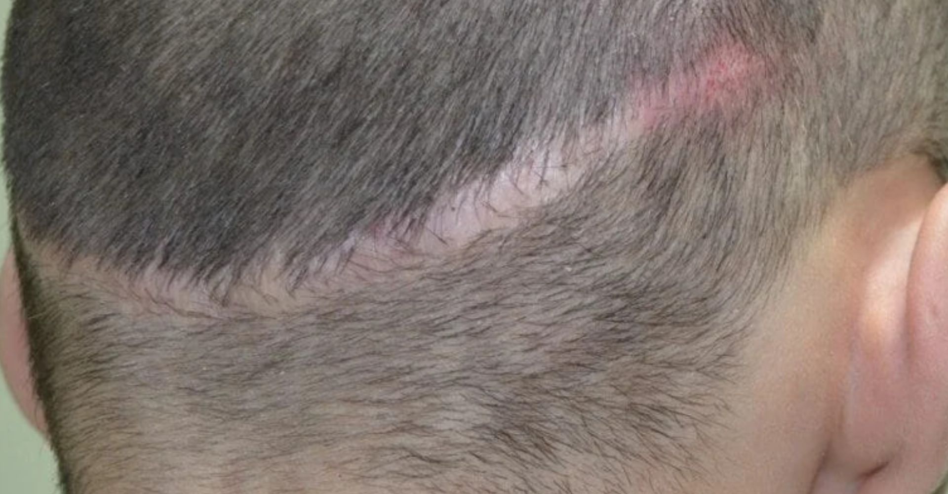 alopecia-cicatricial-o-que-causas-tratamento