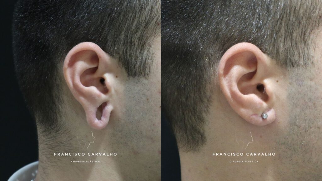 lobuloplastia antes e depois
