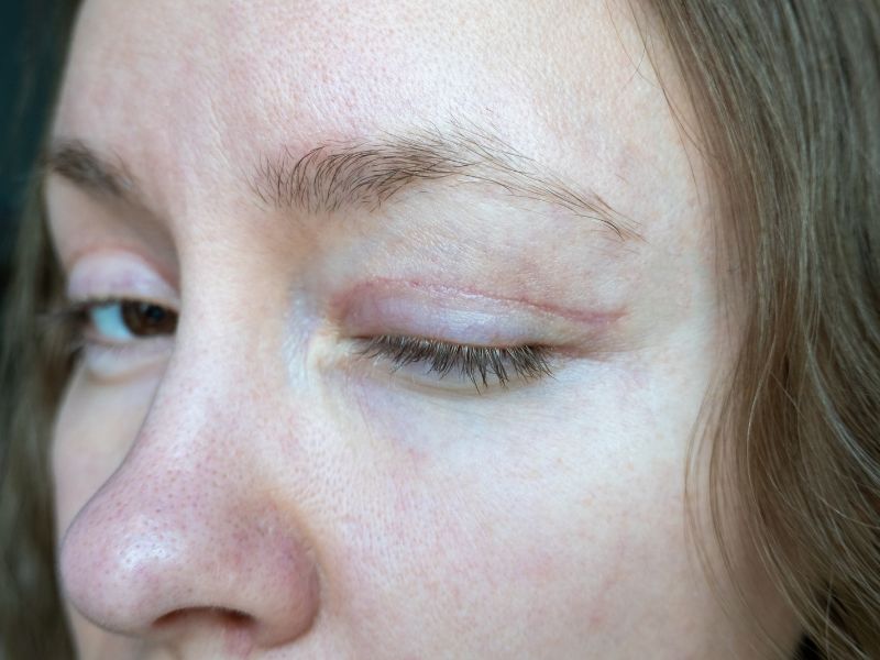 Blepharoplasty scar