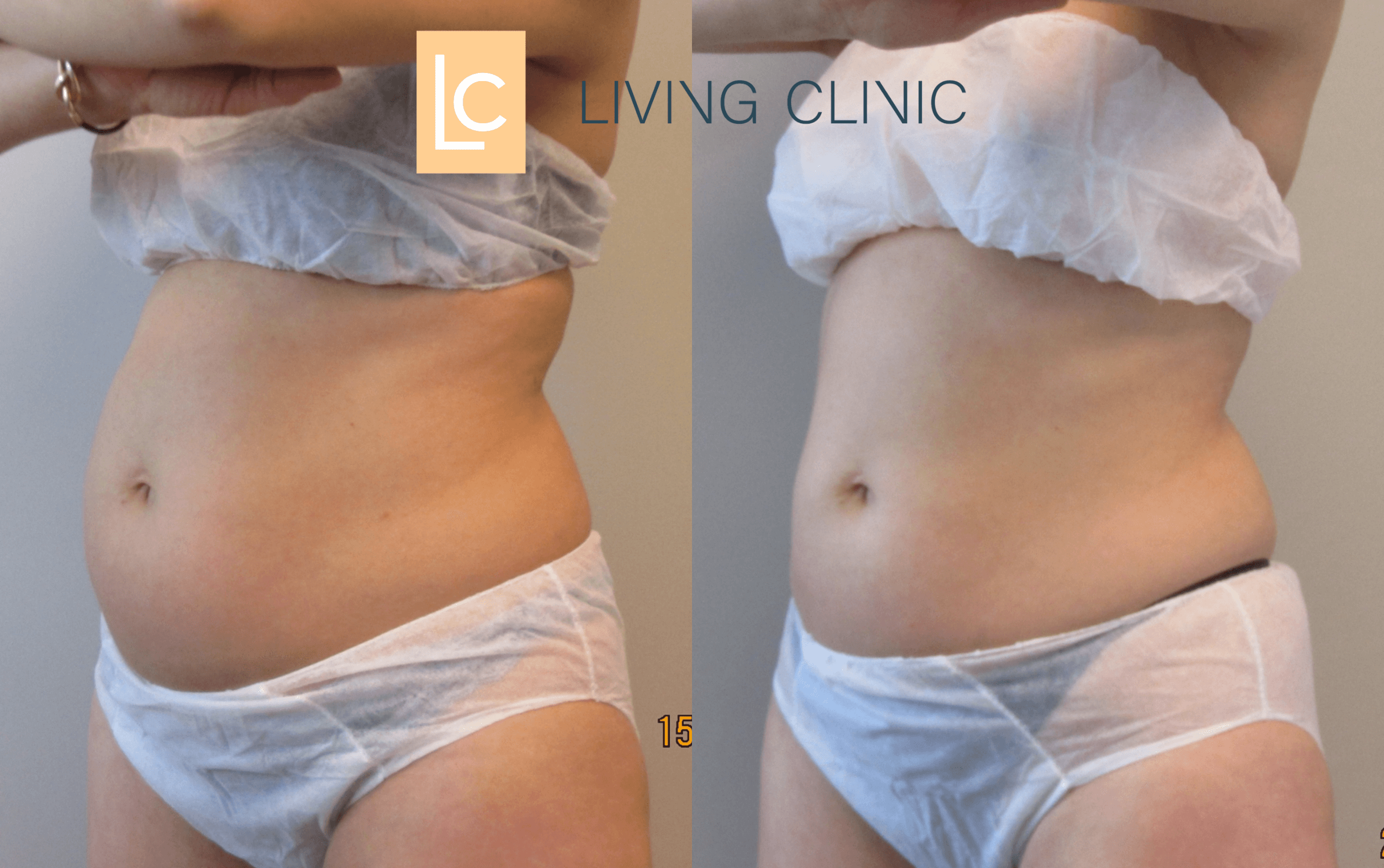 35 year old Female Abdomen Coolsculpting Cryolipolysis Results