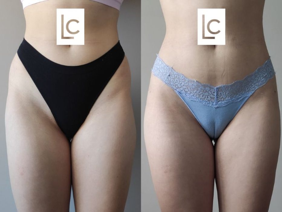 Liposculpture Before and After - Front