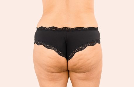 Subcisão de Celulite: Um Tratamento Eficaz para Celulite Grau 2