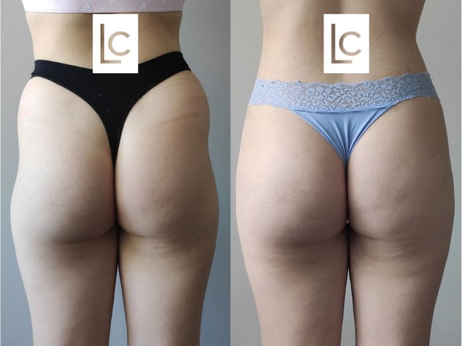 Liposculpture Before and After - Back