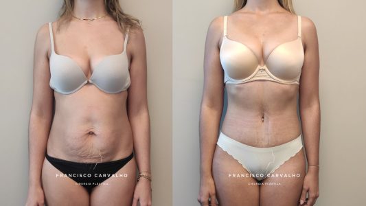 abdominoplastia antes e depois