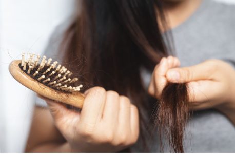 alopecia-androgenetica-feminina
