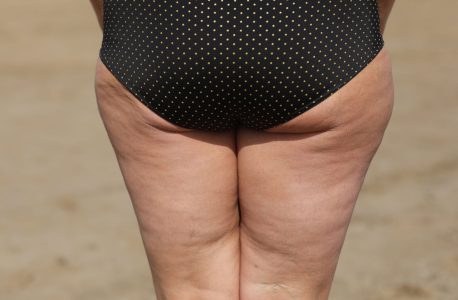 cruroplastia