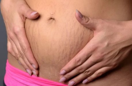 tratamento para estrias vermelhas