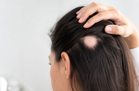 Pessoa a mostrar falha de cabelo no couro cabeludo