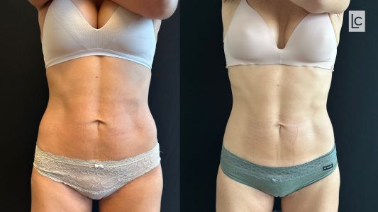 Abdominal Skin Laxity: Before and After