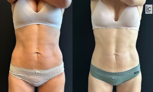 flacidez abdominal antes e depois com tratamentos não invasivos