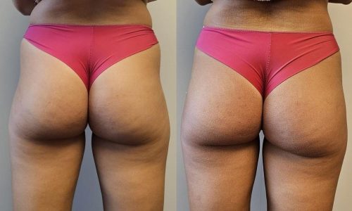 lanluma x before and after