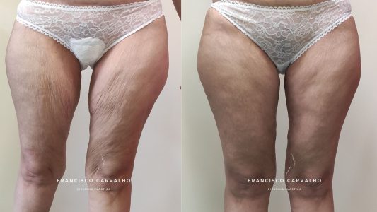 lifting pernas antes e depois