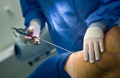 lipoaspiração preço