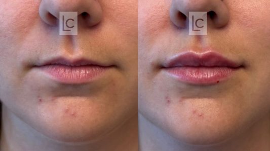Lip filling with Hyaluronic Acid before and after photos
