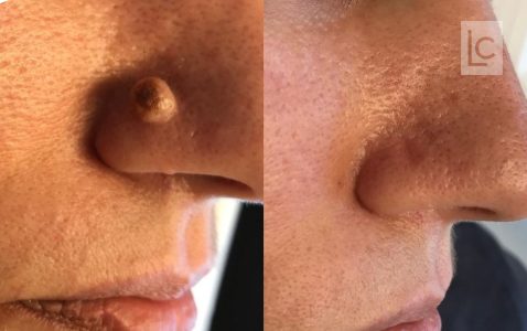 mole removal before and after