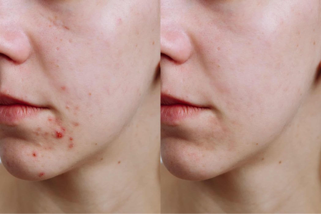 tratamento acne antes e depois