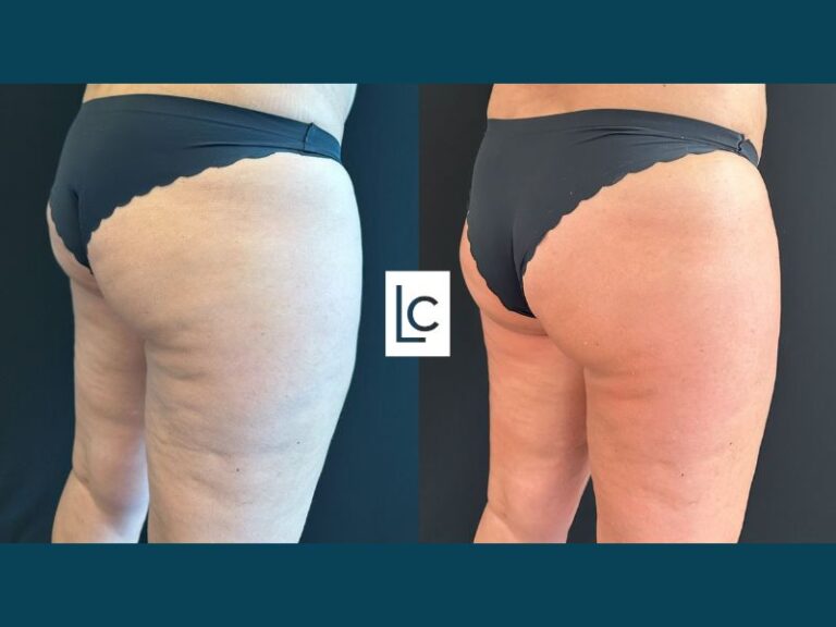emtone Cellulite Before and After