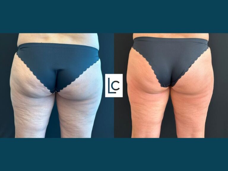 emtone Cellulite Before and After