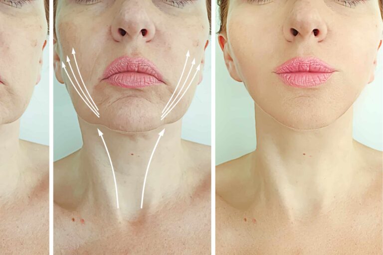 facelift-nao-cirurgico