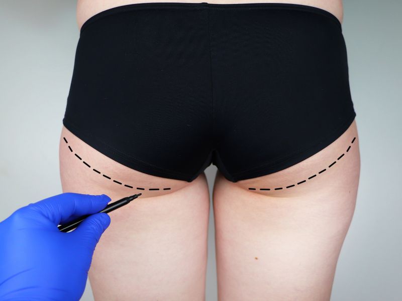 gluteoplastia