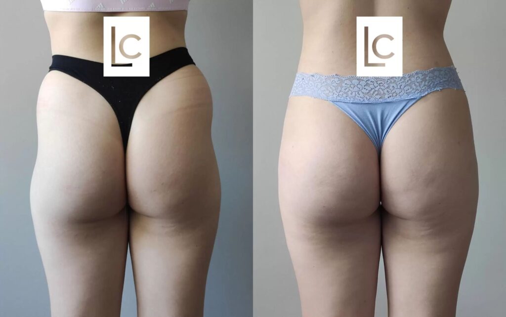 gluteoplastia antes e depois