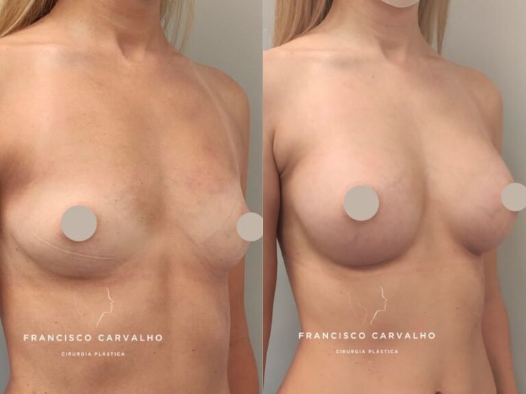 implante mamário antes e depois