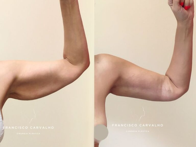 lifting de braços antes e depois