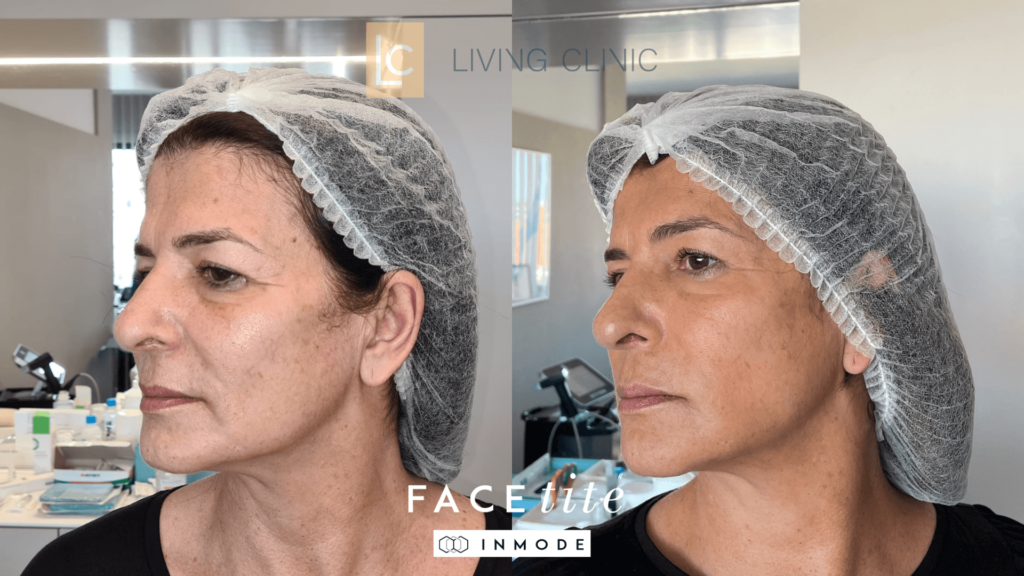 lifting antes e depois