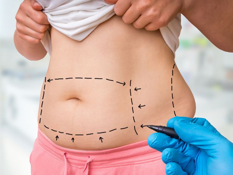 lipoabdominoplastia
