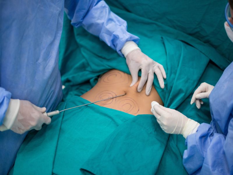scar Liposuction