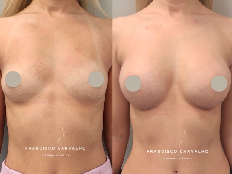 mamoplastia antes e depois
