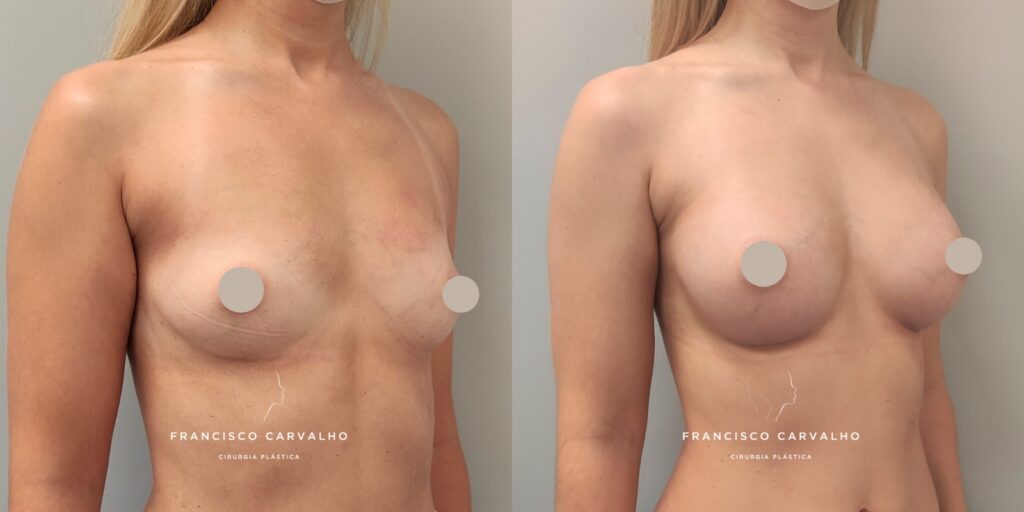 mamoplastia de aumento antes e depois