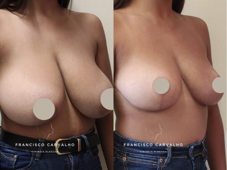mamoplastia redutora antes e depois