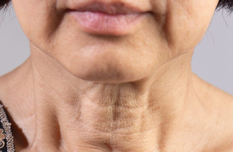 flacidez no pescoço