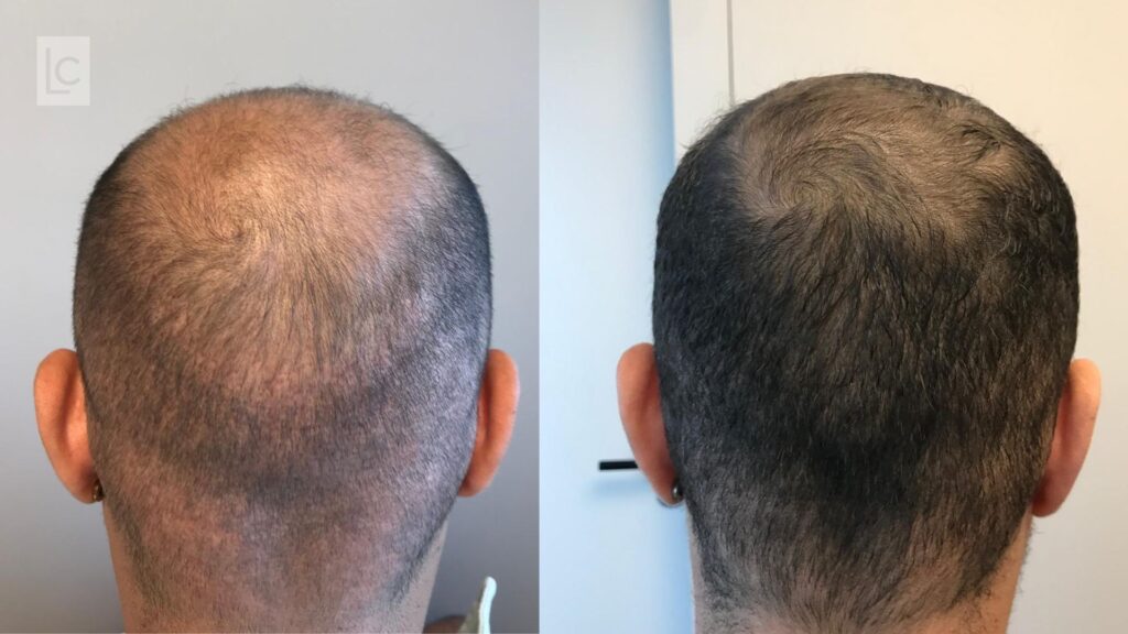 mesoterapia capilar em homem com calvície antes e depois