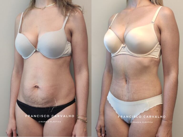 mini abdominoplastia antes e depois